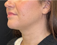 Nonsurgical Fat Reduction After Photo by David Rapaport, MD; New York, NY - Case 47165