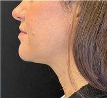 Nonsurgical Fat Reduction After Photo by David Rapaport, MD; New York, NY - Case 47165