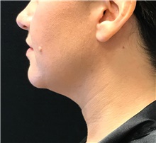 Nonsurgical Fat Reduction Before Photo by David Rapaport, MD; New York, NY - Case 47165