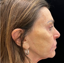 Injectable Fillers After Photo by David Rapaport, MD; New York, NY - Case 47249