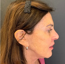Injectable Fillers Before Photo by David Rapaport, MD; New York, NY - Case 47249