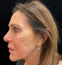 Injectable Fillers After Photo by David Rapaport, MD; New York, NY - Case 47249