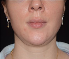 Injectable Fillers Before Photo by David Rapaport, MD; New York, NY - Case 47250