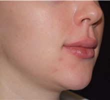 Injectable Fillers After Photo by David Rapaport, MD; New York, NY - Case 47250