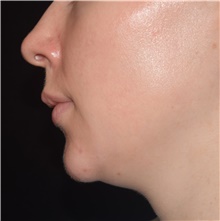 Injectable Fillers Before Photo by David Rapaport, MD; New York, NY - Case 47250