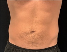 Body Contouring Before Photo by David Rapaport, MD; New York, NY - Case 47251