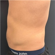 Body Contouring After Photo by David Rapaport, MD; New York, NY - Case 47251