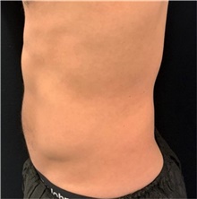Body Contouring Before Photo by David Rapaport, MD; New York, NY - Case 47251