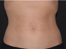 Skin rejuvenation and resurfacing After Photo by David Rapaport, MD; New York, NY - Case 47637