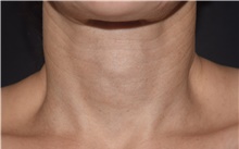 Skin rejuvenation and resurfacing After Photo by David Rapaport, MD; New York, NY - Case 47638