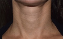 Skin rejuvenation and resurfacing Before Photo by David Rapaport, MD; New York, NY - Case 47638