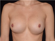 Breast Implant Revision Before Photo by David Rapaport, MD; New York, NY - Case 47639
