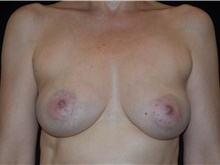 Breast Augmentation After Photo by David Rapaport, MD; New York, NY - Case 47640