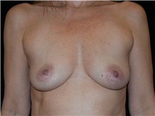 Breast Augmentation Before Photo by David Rapaport, MD; New York, NY - Case 47640