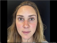 Botulinum Toxin After Photo by David Rapaport, MD; New York, NY - Case 47641