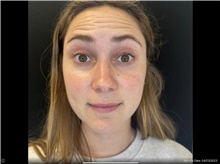 Botulinum Toxin Before Photo by David Rapaport, MD; New York, NY - Case 47641