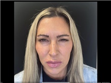 Botulinum Toxin After Photo by David Rapaport, MD; New York, NY - Case 47642