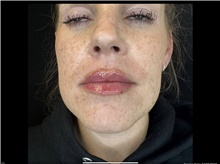 Injectable Fillers After Photo by David Rapaport, MD; New York, NY - Case 47643