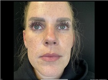Injectable Fillers Before Photo by David Rapaport, MD; New York, NY - Case 47643