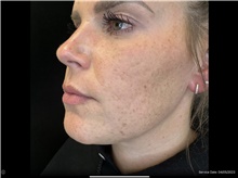 Injectable Fillers Before Photo by David Rapaport, MD; New York, NY - Case 47643