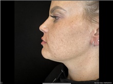 Injectable Fillers After Photo by David Rapaport, MD; New York, NY - Case 47643