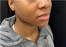 Lip Augmentation/Enhancement Before Photo by David Rapaport, MD; New York, NY - Case 47644