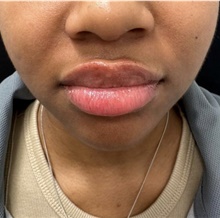 Lip Augmentation/Enhancement After Photo by David Rapaport, MD; New York, NY - Case 47644