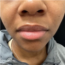 Lip Augmentation/Enhancement Before Photo by David Rapaport, MD; New York, NY - Case 47644