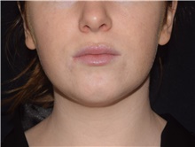 Liposuction Before Photo by David Rapaport, MD; New York, NY - Case 47646