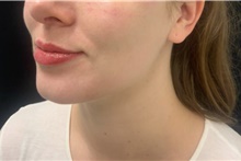 Injectable Fillers After Photo by David Rapaport, MD; New York, NY - Case 47647