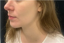 Injectable Fillers Before Photo by David Rapaport, MD; New York, NY - Case 47647