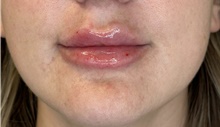 Injectable Fillers After Photo by David Rapaport, MD; New York, NY - Case 47648