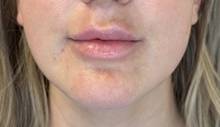 Injectable Fillers Before Photo by David Rapaport, MD; New York, NY - Case 47648