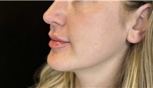 Injectable Fillers After Photo by David Rapaport, MD; New York, NY - Case 47648