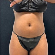 Nonsurgical Fat Reduction Before Photo by David Rapaport, MD; New York, NY - Case 48052