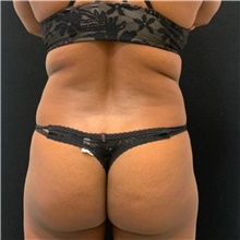 Nonsurgical Fat Reduction Before Photo by David Rapaport, MD; New York, NY - Case 48052