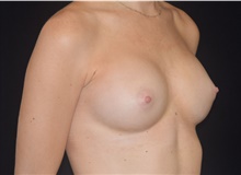Breast Augmentation After Photo by David Rapaport, MD; New York, NY - Case 48053