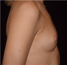 Breast Augmentation Before Photo by David Rapaport, MD; New York, NY - Case 48053