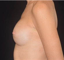 Breast Augmentation After Photo by David Rapaport, MD; New York, NY - Case 48053