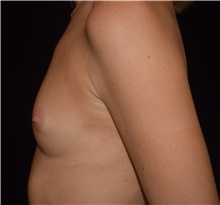 Breast Augmentation Before Photo by David Rapaport, MD; New York, NY - Case 48053