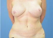 DIEP Flap Breast Reconstruction After Photo by Derek Cody, MD, FACS; Akron, OH - Case 46800