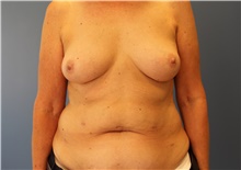 DIEP Flap Breast Reconstruction Before Photo by Derek Cody, MD, FACS; Akron, OH - Case 46800