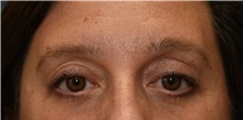 Eyelid Surgery After Photo by Derek Cody, MD, FACS; Akron, OH - Case 46837