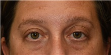 Eyelid Surgery Before Photo by Derek Cody, MD, FACS; Akron, OH - Case 46837