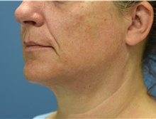 Neck Lift After Photo by Derek Cody, MD, FACS; Akron, OH - Case 46838