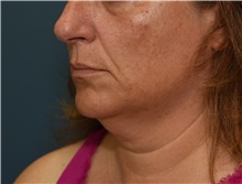 Neck Lift Before Photo by Derek Cody, MD, FACS; Akron, OH - Case 46838
