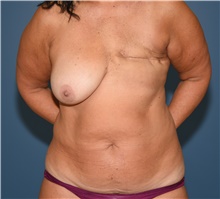 DIEP Flap Breast Reconstruction Before Photo by Derek Cody, MD, FACS; Akron, OH - Case 46839