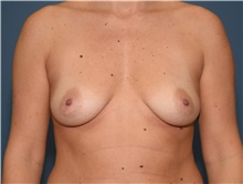 Breast Augmentation Before Photo by Derek Cody, MD, FACS; Akron, OH - Case 46841