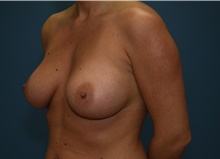 Breast Augmentation After Photo by Derek Cody, MD, FACS; Akron, OH - Case 46841