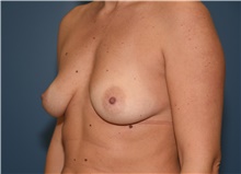 Breast Augmentation Before Photo by Derek Cody, MD, FACS; Akron, OH - Case 46841